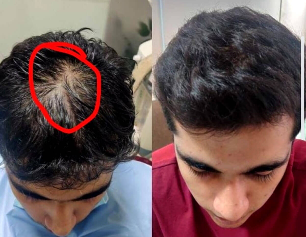 ayurvedic-hair-oil: yellow bee nest oil