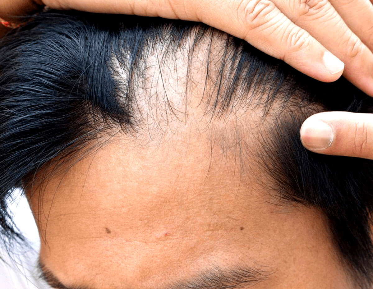 Yellow Bee Nest for Hair Re-Growth